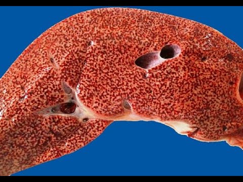 Homeopathic solutions for Liver Treatment